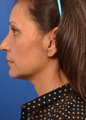 Woman has parotid tumor removal with Dr. Larian and facial reconstruction surgery with Dr. Azizzadeh.