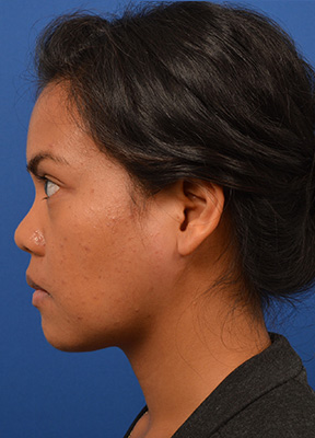 Micro-parotidectomy is utilized to remove large tumor from female patient's left parotid gland. 