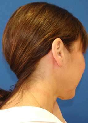 Minimally invasive parotidectomy produces no visible scarring for female patient.
