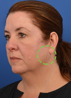 Female patient has a parotid tumor removed from the left side of her face.