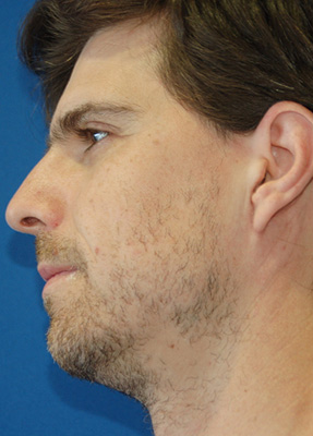 Side view of male patient before and after minimally invasive parotidectomy with no visible scar by Dr. Larian.