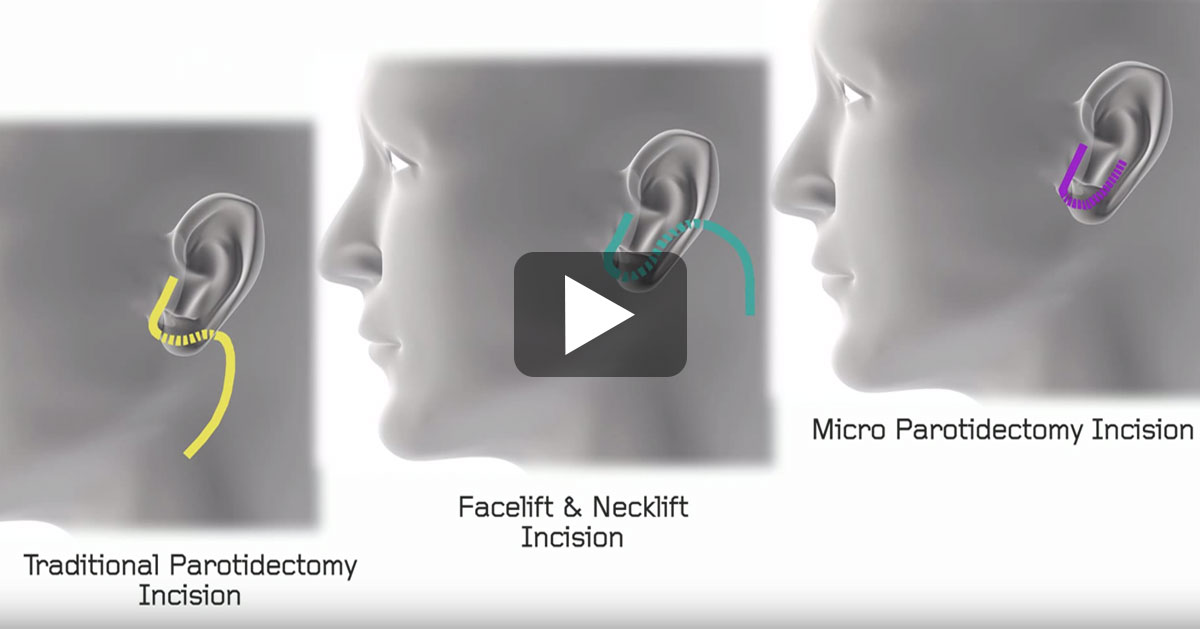 Video of micro parotidectomy