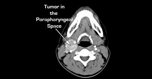 Image of x-ray of a skull with a tumor