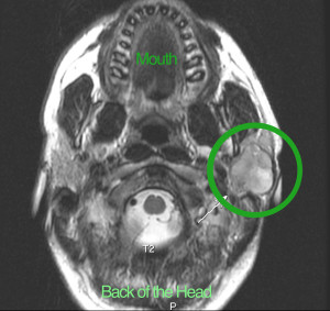 X-ray of tumor