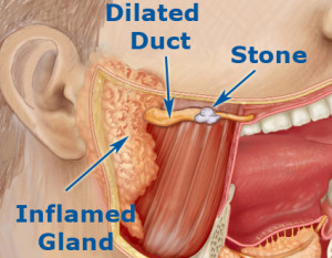 Salivary Gland Stones