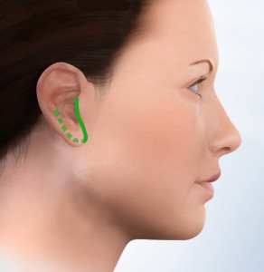 Image showing a micro incision used for micro parotid surgery