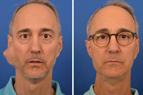Before and after photos of minimally invasive micro-parotidectomy performed by Dr. Larian and Dr. Azizzadeh.