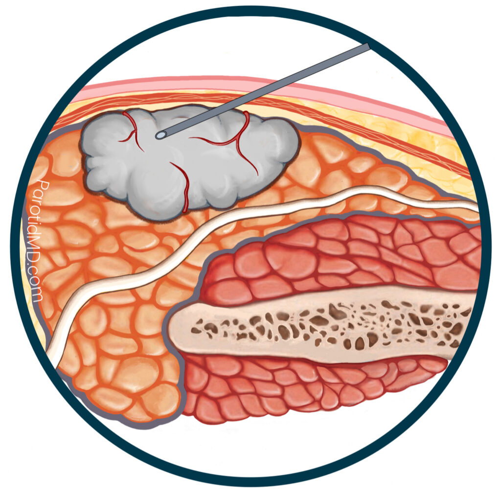 Pleomorphic Adenoma in Beverly Hills, CA | Center for Advanced Parotid ...